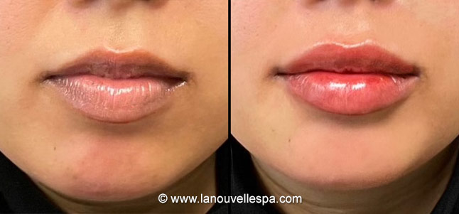 juvederm volbella lip augmentation before after photos by dr. Hanna and Dr. Jack, La Nouvelle Medical Spa, Oxnard, Ventura county  