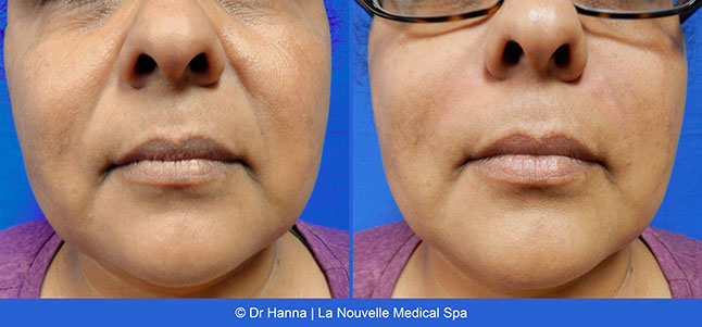 radiesse, juvederm, restylane, voluma before after photos by dr. Hanna, La Nouvelle Medical Spa, Oxnard, Ventura county  