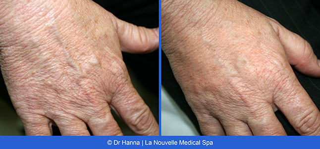 radiesse, juvederm, restylane, voluma before after photos by dr. Hanna, La Nouvelle Medical Spa, Oxnard, Ventura county  