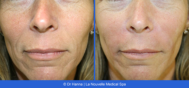 radiesse, juvederm, restylane, voluma before after photos by dr. Hanna, La Nouvelle Medical Spa, Oxnard, Ventura county  