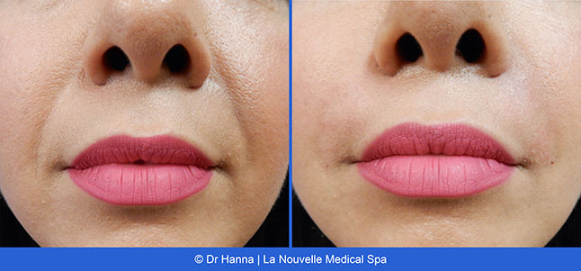 radiesse, juvederm, restylane, voluma before after photos by dr. Hanna, La Nouvelle Medical Spa, Oxnard, Ventura county  