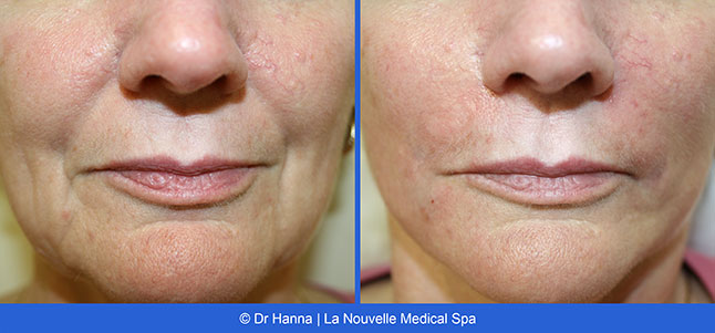 radiesse, juvederm, restylane, voluma before after photos by dr. Hanna, La Nouvelle Medical Spa, Oxnard, Ventura county  