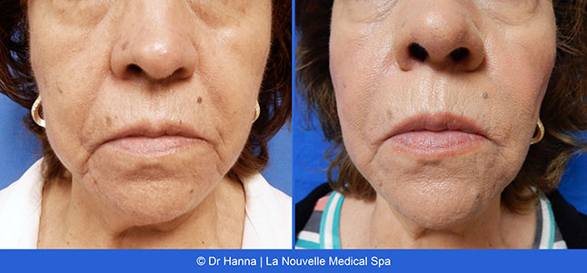 radiesse, juvederm, restylane, voluma before after photos by dr. Hanna, La Nouvelle Medical Spa, Oxnard, Ventura county  