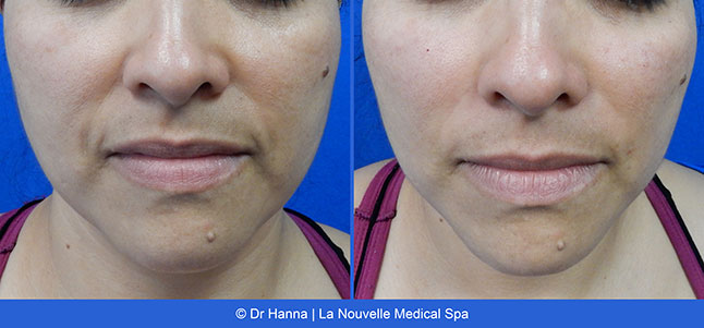 voluma before after photos by dr. Hanna, La Nouvelle Medical Spa, Oxnard, Ventura county  